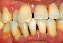 歯周治療後